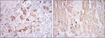 Immunohistochemistry: HSP27 Antibody (5D7) [NBP2-37599] - Immunohistochemical analysis of paraffin-embedded breast cancer tissues (left) and cardiac muscle tissues (right) using HSP27 mouse mAb with DAB staining.