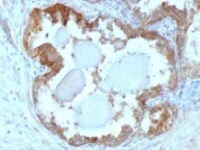 Immunohistochemistry-Paraffin: HSP27 Antibody (G3.1) - Azide and BSA Free [NBP2-34621] - Formalin-fixed. paraffin-embedded human prostate Carcinoma stained with HSP27 Monoclonal Antibody (G3.1)