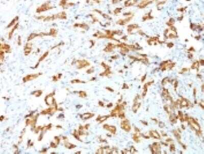 Immunohistochemistry-Paraffin: HSP27 Antibody (G3.1) - Azide and BSA Free [NBP2-34621] - Formalin-fixed. paraffin-embedded human Breast Carcinoma stained with HSP27 Monoclonal Antibody (G3.1)