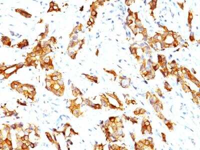 Immunohistochemistry-Paraffin: HSP27 Antibody (HSPB1/774) - IHC-Prediluted [NBP2-48186] - Formalin-fixed, paraffin-embedded human Breast Carcinoma stained with HSP27 Monoclonal Antibody (HSPB1/774)