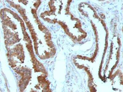 Immunohistochemistry-Paraffin: HSP27 Antibody (HSPB1/774) - IHC-Prediluted [NBP2-48186] - Formalin-fixed, paraffin-embedded human Prostate Carcinoma stained with HSP27 Monoclonal Antibody (HSPB1/774)