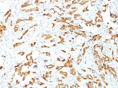 Immunohistochemistry-Paraffin: HSP27 Antibody (SPM252) - Azide and BSA Free [NBP2-34751] - Formalin-paraffin breast carcinoma (10X) stained with HSP27 MAb (SPM252))