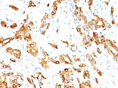 Immunohistochemistry-Paraffin: HSP27 Antibody (SPM252) - Azide and BSA Free [NBP2-34751] - Formalin-paraffin breast carcinoma (20X) stained with HSP27 MAb (SPM252)