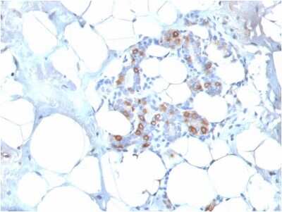 Immunohistochemistry-Paraffin: HSP27 Antibody (SPM252) - Azide and BSA Free [NBP2-34751] - Formalin-fixed, paraffin-embedded human breast carcinoma stained with HSP27 Mouse Monoclonal Antibody (SPM252).