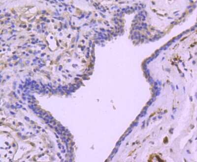 Immunohistochemistry-Paraffin: HSP27 [p Ser78] Antibody (JJ08-70) [NBP2-67844] - Analysis of paraffin-embedded human breast carcinoma tissue using anti-Phospho-Hsp27(S78) antibody. Counter stained with hematoxylin.