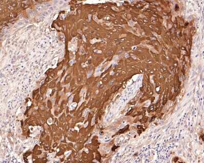 Immunohistochemistry-Paraffin: HSP27 [p Ser78] Antibody (JJ08-70) [NBP2-67844] - Analysis of paraffin-embedded human cervical carcinoma tissue with Rabbit anti-Phospho-Hsp27(S78) antibody washed with ddH2O and PBS, and then probed with the primary antibody at 1/400 dilution for 1 hour at room temperature. The detection was performed using an HRP conjugated compact polymer system. DAB was used as the chromogen. Tissues were counterstained with hematoxylin and mounted with DPX.