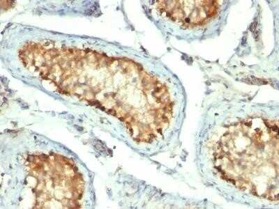 Immunohistochemistry-Paraffin: HSP60 Antibody (GROEL/730) - IHC-Prediluted [NBP2-44757] - Formalin-fixed, paraffin-embedded human Testicular Carcinoma stained with HSP60 Monoclonal Antibody (GROEL/730)