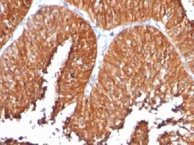 Immunohistochemistry-Paraffin: HSP60 Antibody (SPM253) - Azide and BSA Free [NBP2-34734] - Formalin-fixed, paraffin-embedded human bladder carcinoma stained with HSP60 Monoclonal Antibody (SPM253)