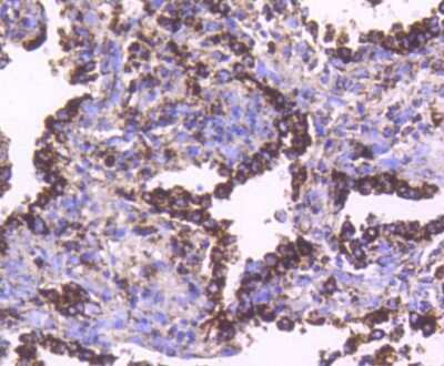 Immunohistochemistry-Paraffin: HSP60 Antibody (ST48-04) [NBP2-67517] - Analysis of paraffin-embedded human lung cancer tissue using anti-Hsp60 antibody. Counter stained with hematoxylin.