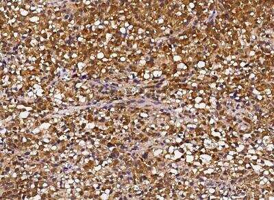 Immunohistochemistry-Paraffin: HSP70/HSPA1A Antibody (001) [NBP2-89951] - Staining of HSPA1A in human hepatoma with rabbit monoclonal antibody (1:1000).