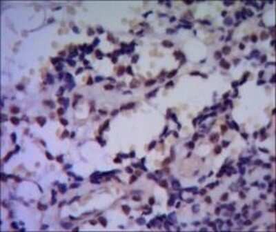 Immunohistochemistry-Paraffin: HspA4 Antibody (5A6) [NBP1-51592] - Immunohistochemical analysis of paraffin-embedded human breast cancer using HSP70 mouse mAb with DAB staining.