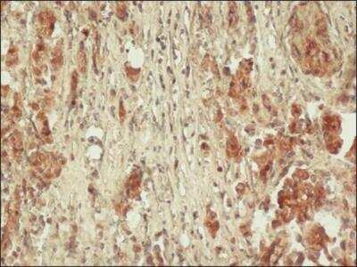 Immunohistochemistry: HSP70/HSPA1A Antibody (BRM-22) [NB600-1165] - Staining of formalin-fixed, paraffin-embedded human prostate sections with 1:100 Monoclonal Anti-HSP70 / HSPA1A, Clone: BRM-22 using biotin/ExtrAvidin-Peroxidase.