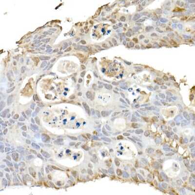 Immunohistochemistry-Paraffin: HSP70/HSPA1A Antibody [NBP3-16090] - Immunohistochemistry of paraffin-embedded human colon carcinoma using HSP70/HSPA1A Rabbit pAb (NBP3-16090) at dilution of 1:150 (40x lens).Perform high pressure antigen retrieval with 10 mM citrate buffer pH 6.0 before commencing with IHC staining protocol.