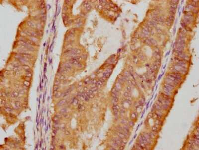 Immunohistochemistry: HSP90 Antibody (4F8) [NBP3-15146] - IHC image of HSP90 diluted at 1:87.5 and staining in paraffin-embedded human endometrial cancer. After dewaxing and hydration, antigen retrieval was mediated by high pressure in a citrate buffer (pH 6.0). Section was blocked with 10% normal goat serum 30 minutes at RT. Then primary antibody (1% BSA) was incubated at 4C overnight. The primary is detected by a biotinylated secondary antibody and visualized using an HRP conjugated SP system.