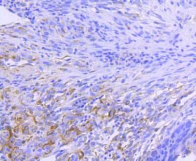 Immunohistochemistry-Paraffin: HSP90 alpha Antibody (SY14-06) [NBP2-67396] - Analysis of paraffin-embedded human colon cancer tissue using anti-Hsp90 alpha antibody. Counter stained with hematoxylin.