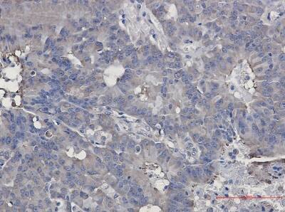 Immunohistochemistry-Paraffin: HSP90 beta Antibody (S03-8F1) [NBP3-19877] - Immunohistochemistry of HSP90 beta in paraffin-embedded Human breast cancer tissue using NBP3-19877 at dilution 1/50