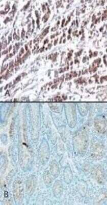 Immunohistochemistry: HTRA2/Omi Antibody (196C429) - Azide and BSA Free [NBP2-80782] - Analysis of HtrA2 using an HtrA2 monoclonal antibody. Probing with HtrA2 antibody shows staining in stomach tumor tissue (A) and very weak staining in normal stomach tissue (B). Image from the standard format of this antibody.