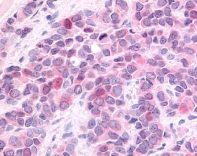 Immunohistochemistry-Paraffin: HUNK Antibody [NLS6922] - Analysis of anti-HUNK / B19 antibody with human breast, carcinoma.