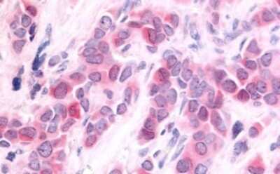 Immunohistochemistry-Paraffin: HUNK Antibody [NLS6922] - Anti-HUNK / B19 antibody IHC of human Breast, Carcinoma. Immunohistochemistry of formalin-fixed, paraffin-embedded tissue after heat-induced antigen retrieval.