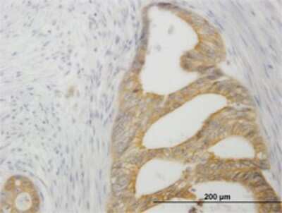 Immunohistochemistry-Paraffin: HVEM/TNFRSF14 Antibody (2G6-2C7) [H00008764-M01] - Analysis of monoclonal antibody to TNFRSF14 on formalin-fixed paraffin-embedded human pancreatic cancer. Antibody concentration 1 ug/ml.