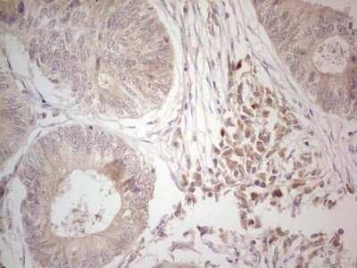 Immunohistochemistry: Hairless Antibody (OTI1D9) - Azide and BSA Free [NBP2-72023] - Analysis of Adenocarcinoma of Human colon tissue. (Heat-induced epitope retrieval by Tris-EDTA, pH8.0)