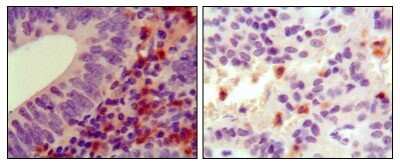 Immunohistochemistry-Paraffin: Hck Antibody (3D12E10) [NBP1-47514] - Analysis of human colon cancer (left) and ancreas cancer (right), showing cytoplasmic localization using HCK mouse mAb with DAB staining.