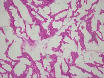 Hematoxylin & Eosin Stain: Heart Atrium Tissue Slides (Arrhythmia Left) [NBP2-77621] - Tissue: Human Heart (left Atrium),  Pathology: Arrythmia, infarct