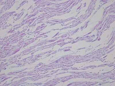 Hematoxylin & Eosin Stain: Heart Atrium Tissue Slides (Arrhythmia Right) [NBP2-77850] - Tissue: Human Heart (right Atrium),  Pathology: Arrythmia, infarct