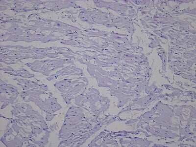 Hematoxylin & Eosin Stain: Heart Atrium Tissue Slides (Hypertension Left) [NBP2-77965] - Tissue: Human Heart (left Atrium),  Pathology: Hypertension