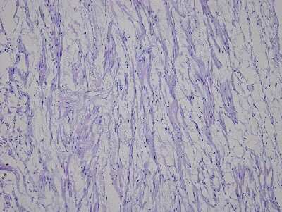 Hematoxylin & Eosin Stain: Heart Atrium Tissue Slides (Hypertension Right) [NBP2-77966] - Tissue: Human Heart (right Atrium),  Pathology: Hypertension