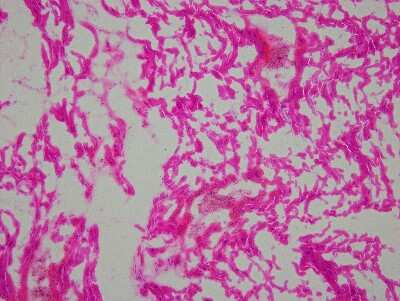 Hematoxylin & Eosin Stain: Heart Ventricle Tissue Slides (Hypertension Left) [NBP2-77655] - Tissue: Human Heart (left Ventricle),  Pathology: Hypertension