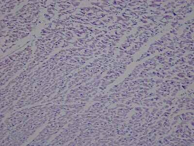 Hematoxylin & Eosin Stain: Heart Ventricle Tissue Slides (Hypertension Left) [NBP2-77967] - Tissue: Human Heart (left Ventricle),  Pathology: Hypertension