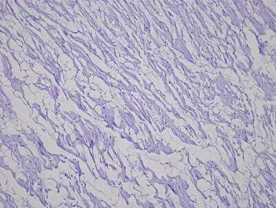 Hematoxylin & Eosin Stain: Heart Ventricle Tissue Slides (Hypertension Right) [NBP2-77968] - Tissue: Human Heart (right Ventricle),  Pathology: Hypertension