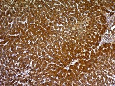 Immunohistochemistry-Paraffin: Hepatocyte Specific Antigen Antibody (HepPar1) - Azide and BSA Free [NBP3-08970] - Formalin-fixed, paraffin-embedded human Hepatocellular Carcinoma stained with Hepatocyte Specific Antigen Mouse Monoclonal Antibody (HepPar1).
