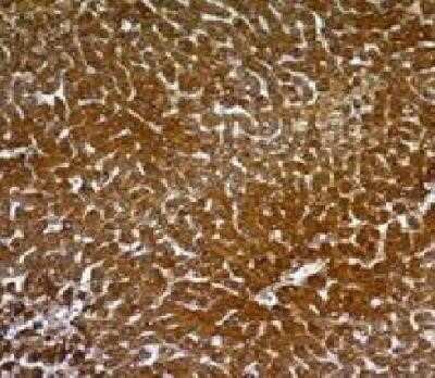 Immunohistochemistry-Paraffin: Hepatocyte Specific Antigen Antibody (OCH1E5) - Azide and BSA Free [NBP2-34699] - Hepatocellular carcinoma stained with HSA monoclonal antibody