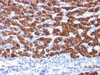 Immunohistochemistry-Paraffin: Hepatocyte Specific Antigen Antibody (OCH1E5) - Azide and BSA Free [NBP2-34699] - Formalin-fixed, paraffin-embedded human Hepatocellular Carcinoma stained with Hepatocyte Specific Antigen Antibody (OCH1E5).