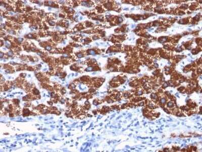 Immunohistochemistry-Paraffin: Hepatocyte Specific Antigen Antibody (OCH1E5) - IHC-Prediluted [NBP2-45193] - Formalin-fixed, paraffin-embedded human Hepatocellular Carcinoma stained with Hepatocyte Specific Antigen Antibody (OCH1E5).