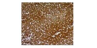Immunohistochemistry-Paraffin: Hepatocyte Specific Antigen Antibody (SPM582) - Azide and BSA Free [NBP2-34814] - Formalin-fixed, paraffin-embedded human Hepatocellular Carcinoma stained with HSA Monoclonal Antibody (SPM582).