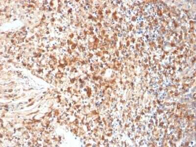 Immunohistochemistry-Paraffin: Herpes Simplex Virus 1 Antibody (HSVI/2095) - Azide and BSA Free [NBP3-08465] - Formalin-fixed, paraffin-embedded human Cervix stained with Herpes Simplex Virus 1 Mouse Monoclonal Antibody (Herpes Simplex Virus 1/2095).