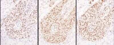 Immunohistochemistry: Hexim 1 Antibody [NBP1-71866] - Samples: FFPE serial sections of human lung cancer. Antibody: Affinity purified rabbit anti- HEXIM1 used at a dilution of 1:200 (1ug/ml) ( ) or 1:1,000 (1ug/ml) ( and ). Detection: DAB. Counterstain: hematoxylin (blue).