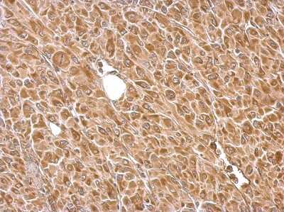 Immunohistochemistry-Paraffin: Hexokinase 2 Antibody [NBP2-16814] -  U87 xenograft. Hexokinase II antibody dilution: 1:500. Antigen Retrieval: Trilogy™ (EDTA based, pH 8.0) buffer, 15min.