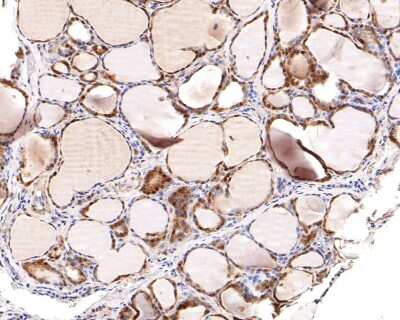 Immunohistochemistry-Paraffin: Histone Deacetylase 2/HDAC2 Antibody (SD0816) [NBP2-67781] - Analysis of paraffin-embedded human thyroid tissue with Rabbit anti-Deacetylase 2/HDAC2 antibody washed with ddH2O and PBS, and then probed with the primary antibody at 1/200 dilution for 1 hour at room temperature. The detection was performed using an HRP conjugated compact polymer system. DAB was used as the chromogen. Tissues were counterstained with hematoxylin and mounted with DPX.