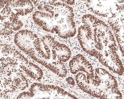 Immunohistochemistry-Paraffin: Histone Deacetylase 2/HDAC2 Antibody (SD0816) [NBP2-67781] - Analysis of paraffin-embedded human colon carcinoma tissue with Rabbit anti-Deacetylase 2/HDAC2 antibody washed with ddH2O and PBS, and then probed with the primary antibody at 1/200 dilution for 1 hour at room temperature. The detection was performed using an HRP conjugated compact polymer system. DAB was used as the chromogen. Tissues were counterstained with hematoxylin and mounted with DPX.