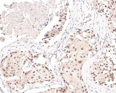 Immunohistochemistry-Paraffin: Histone Deacetylase 2/HDAC2 Antibody (SD0816) [NBP2-67781] - Analysis of paraffin-embedded human breast carcinoma tissue with Rabbit anti-Histone Deacetylase 2/HDAC2 antibody washed with ddH2O and PBS, and then probed with the primary antibody  at 1/200 dilution for 1 hour at room temperature. The detection was performed using an HRP conjugated compact polymer system. DAB was used as the chromogen. Tissues were counterstained with hematoxylin and mounted with DPX.