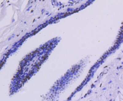 Immunohistochemistry-Paraffin: Histone Deacetylase 2/HDAC2 Antibody (SY29-02) [NBP2-67451] - Analysis of paraffin-embedded human breast carcinoma tissue using anti-HDAC2 antibody. Counter stained with hematoxylin.
