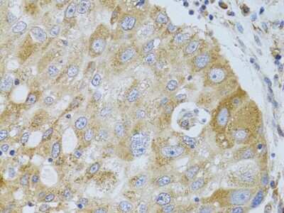 Immunohistochemistry-Paraffin: Histone Deacetylase 8/HDAC8 Antibody [NBP3-03473] - Human breast cancer using Histone Deacetylase 8/HDAC8 antibody at dilution of 1:100 (40x lens).