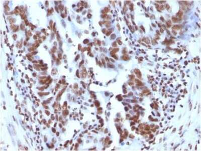 Immunohistochemistry-Paraffin: H1F0 Antibody (1415-1) - Azide and BSA Free [NBP2-47752] - Formalin-fixed, paraffin-embedded human Ovarian Carcinoma stained with H1F0 antibody (1415-1) - Azide and BSA Free