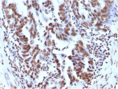 Immunohistochemistry-Paraffin: H1F0 Antibody (1415-1) - IHC-Prediluted [NBP2-48078] - Formalin-fixed, paraffin-embedded human Ovarian Carcinoma stained with H1F0 antibody (1415-1) - IHC-Prediluted