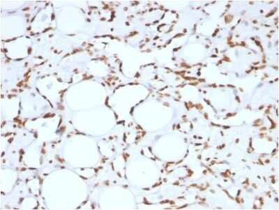 Immunohistochemistry-Paraffin: Histone H1 Antibody (HH1/957) - IHC-Prediluted [NBP2-48087] - Formalin-fixed, paraffin-embedded human Angiosarcoma stained with Histone H1 Antibody (HH1/957).