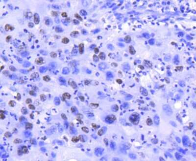 Immunohistochemistry-Paraffin: Histone H2A.Z Antibody (ST46-09) [NBP2-67499] - Analysis of paraffin-embedded human lung cancer tissue using anti-Histone H2A.Z antibody. Counter stained with hematoxylin.